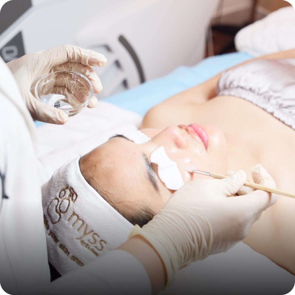 peel mụn, điều trị mụn