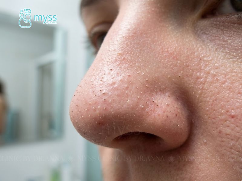 Mụn cám là gì? Nguyên nhân, dấu hiệu và cách điều trị hiệu quả