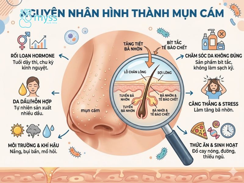 Nguyên nhân hình thành mụn cám