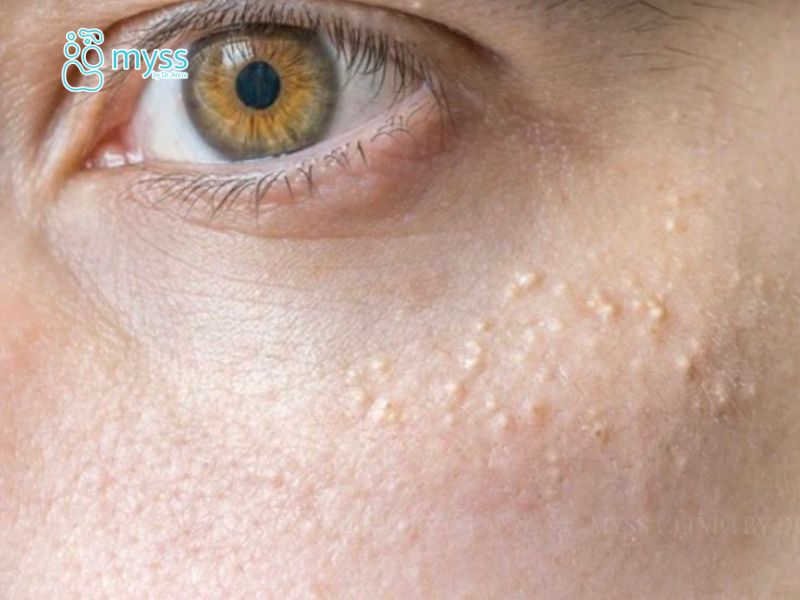 Mụn cơm là gì? Dấu hiệu, nguyên nhân và cách khắc phục