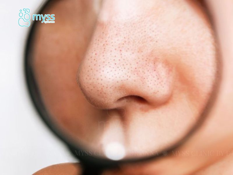 Mụn đầu đen: Nguyên nhân hình thành và trị mụn đầu đen