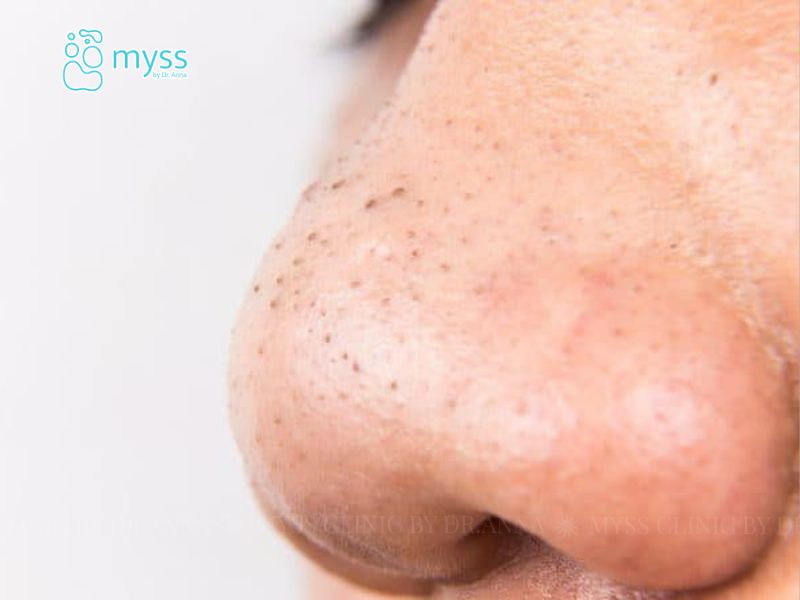 Mụn đầu đen có tự hết không?