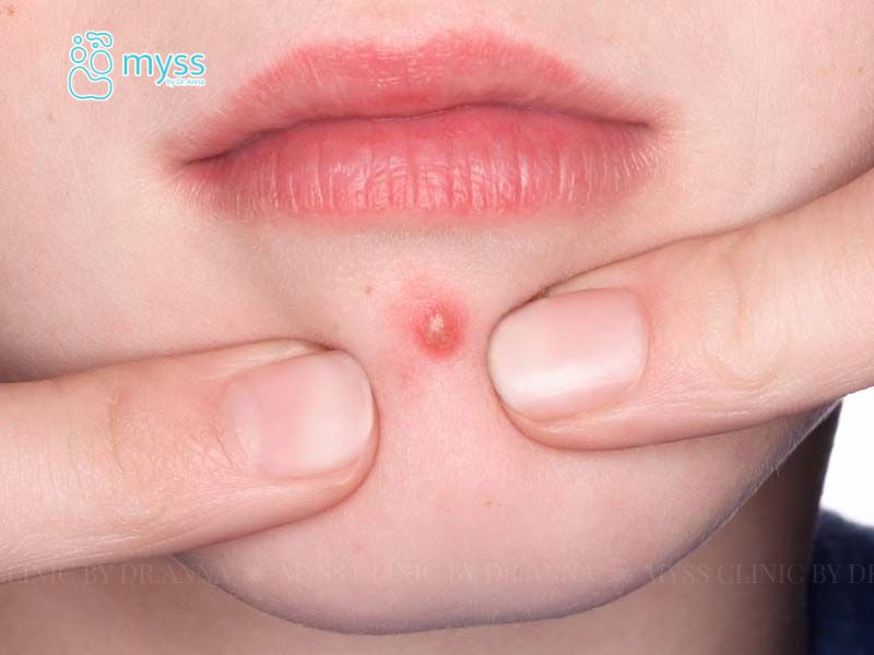 Mụn đinh râu là gì? Cách nhận biết và xử lý an toàn