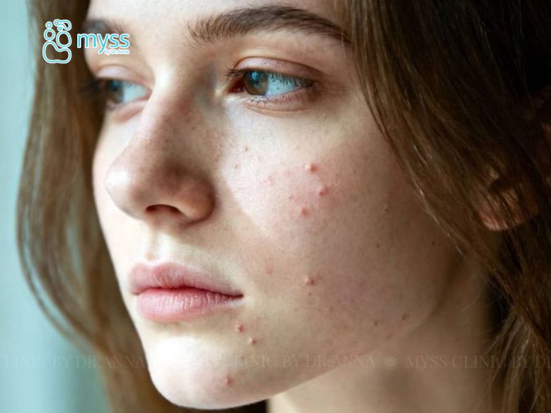 Cách điều trị xử lý mụn đinh râu đúng cách