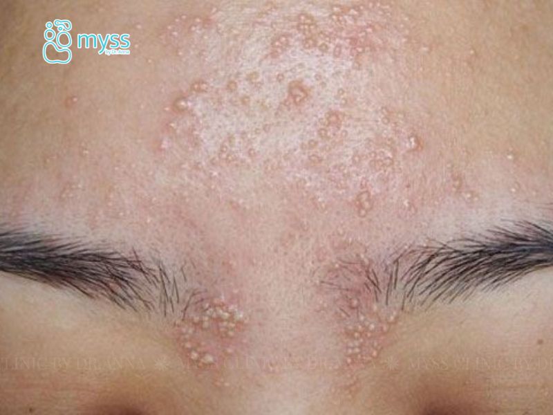 Các vị trí dễ bị mụn ẩn