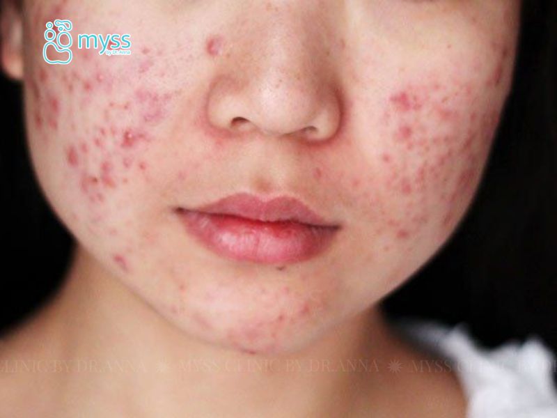 Mụn bọc là gì? Nguyên nhân và cách trị mụn hiệu quả