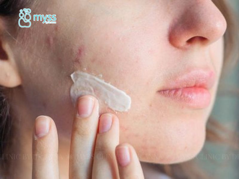 Cách trị mụn bọc với thuốc bôi