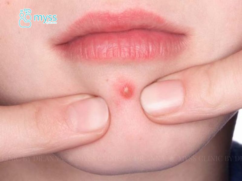 Mụn nhọt: Nguyên nhân, dấu hiệu và cách khắc phục hiệu quả