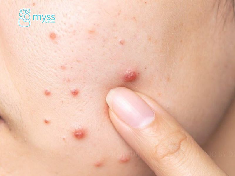 Dấu hiệu bị mụn nhọt