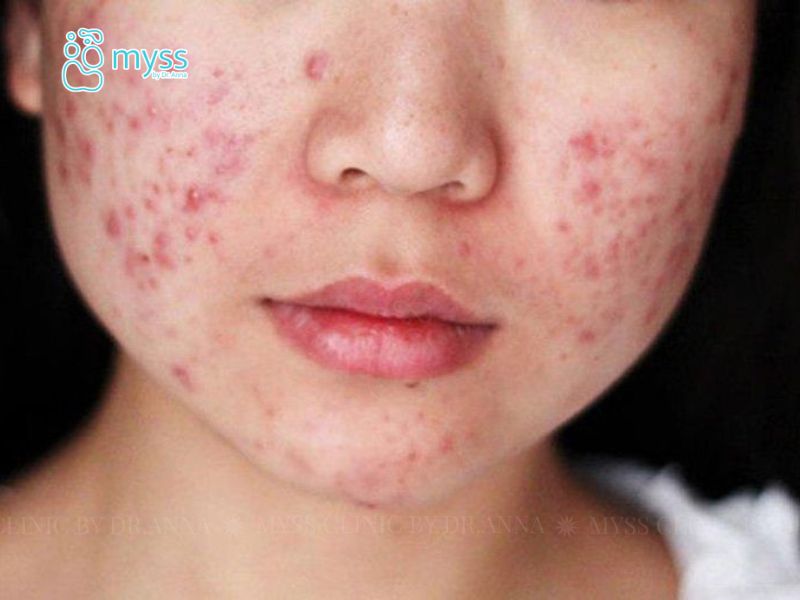 Mụn trứng cá là gì? Nguyên nhân và cách điều trị hiệu quả
