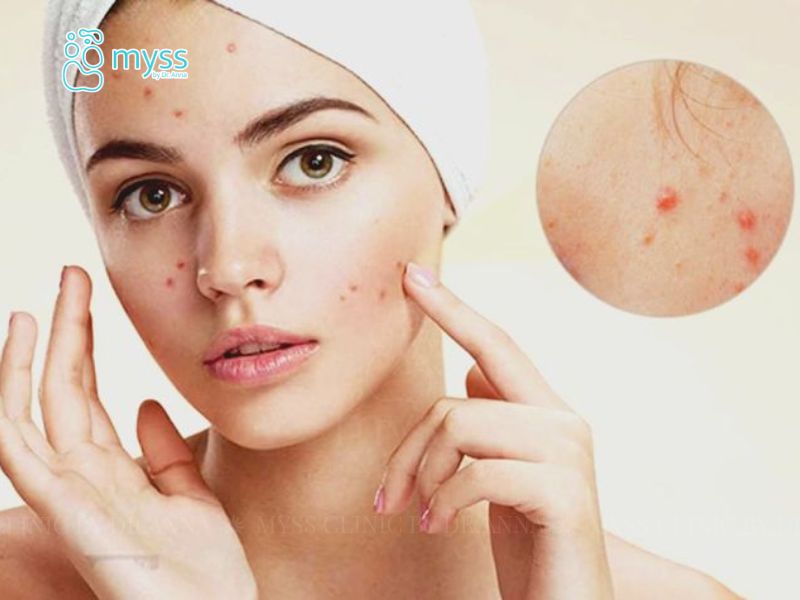 Nguyên nhân gây ra mụn trứng cá