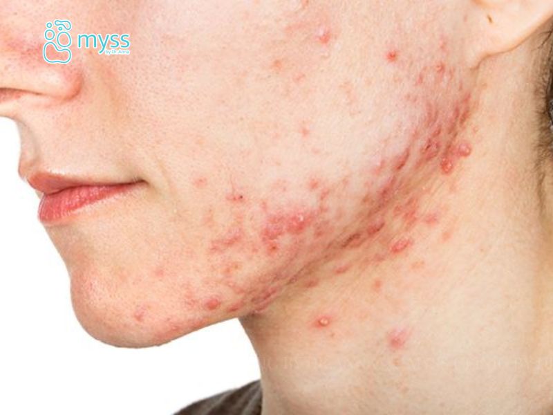 Mụn viêm là gì? Nguyên nhân và cách điều trị hiệu quả