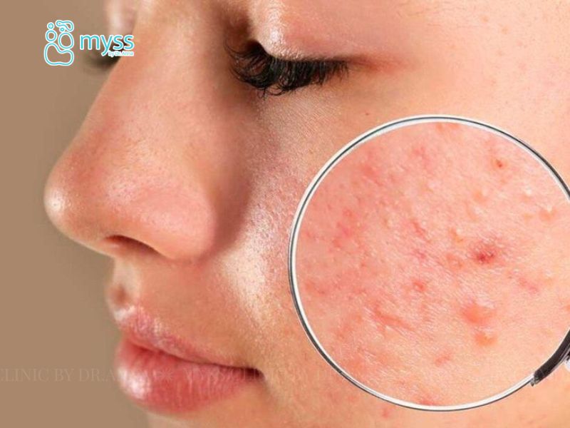 loại mụn viêm đỏ phổ biến