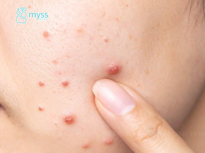 Loại mụn viêm mủ