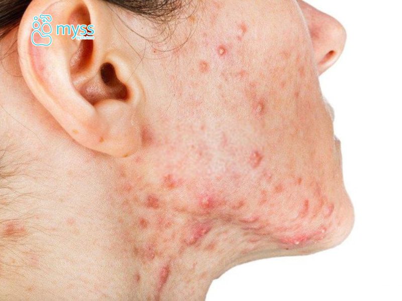 Mụn viêm dạng bọc