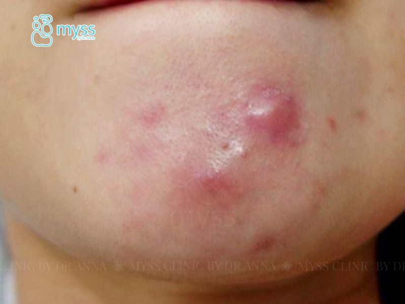 Mụn viêm dạng nang