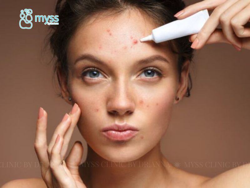 Mụn viêm có tự hết không?