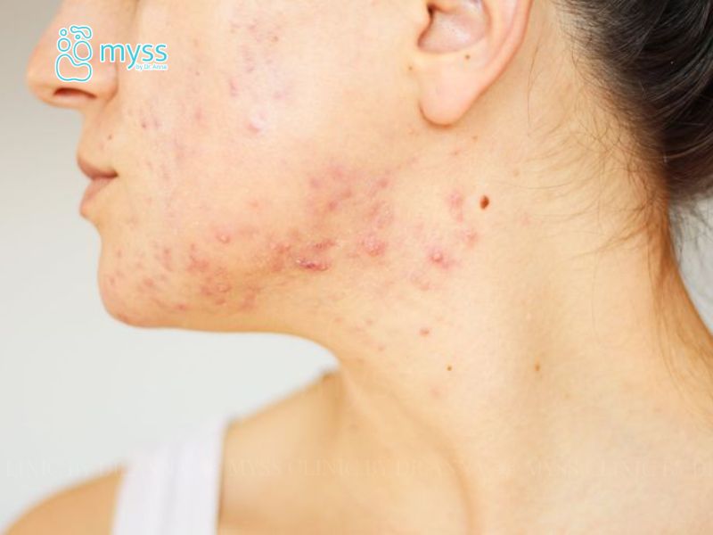 Da bị nổi sần như da gà và ngứa cảnh báo bệnh gì?