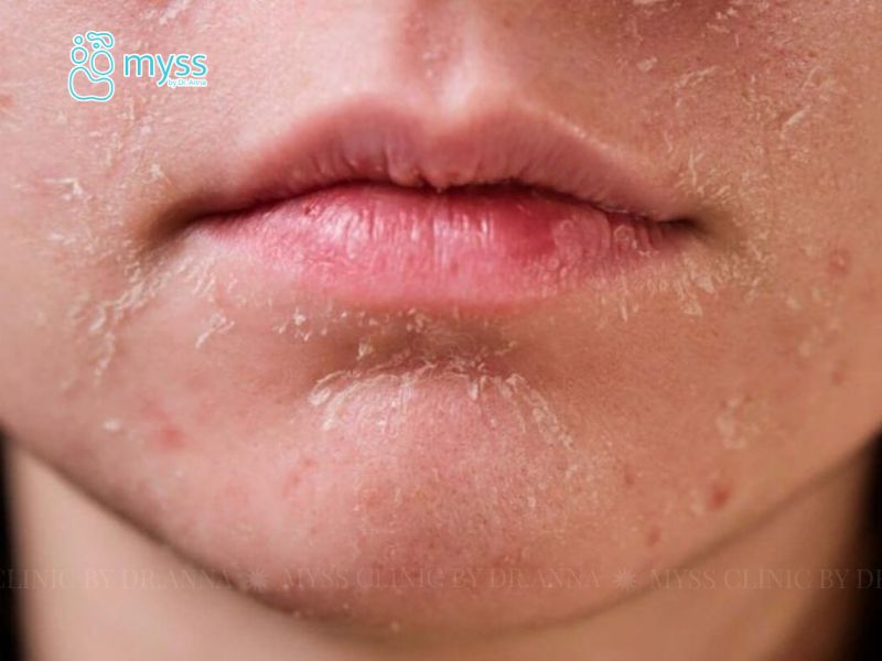 Nguyên nhân da mặt khô bong tróc​ và cách khắc phục hiệu quả