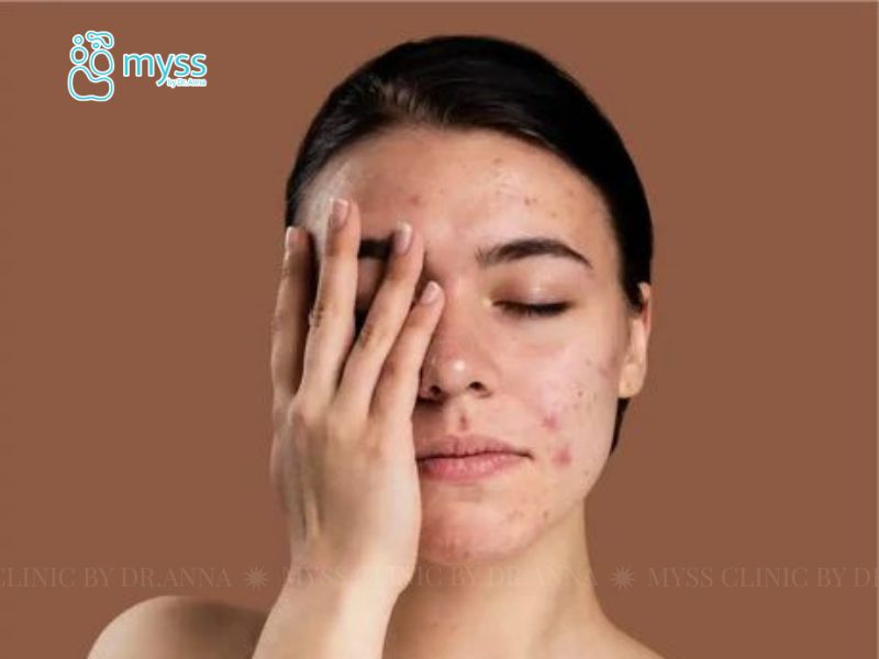 Mụn kích ứng là gì? Phân biệt mụn kích ứng với các mụn khác