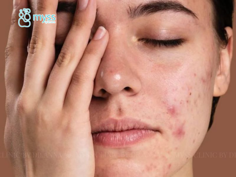 Mụn nội tiết là gì? Nguyên nhân và cách điều trị an toàn
