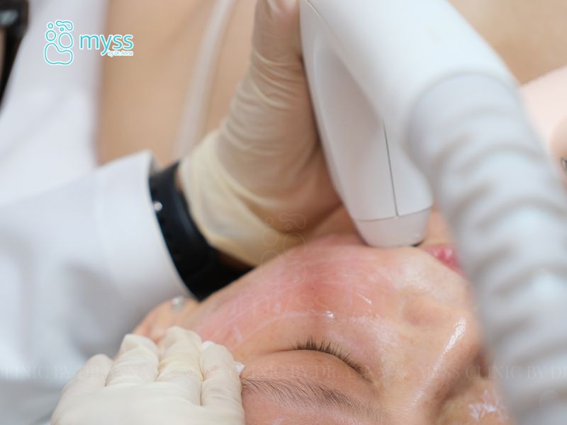 So sánh Sofwave với các công nghệ trẻ hóa da khác