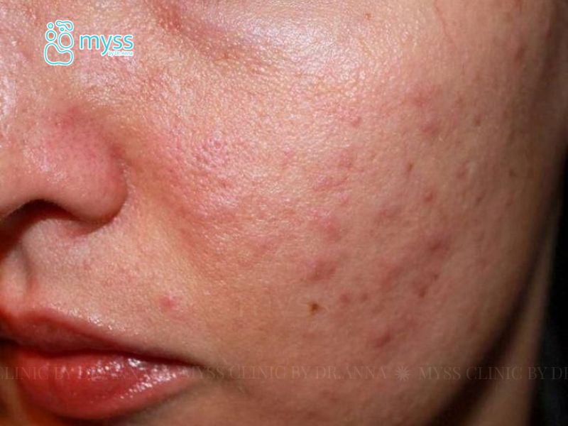 Da mặt đột nhiên nổi nhiều mụn​ do đâu? Cách trị hiệu quả