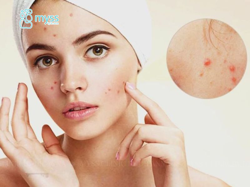 Da mặt đột nhiên nổi nhiều mụn do đâu?