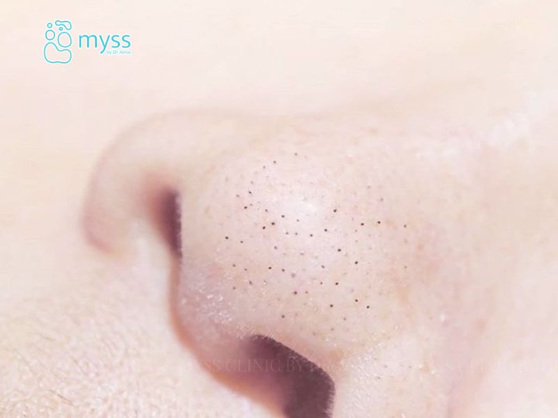 Phân biệt các loại mụn thường nổi trên da mặt