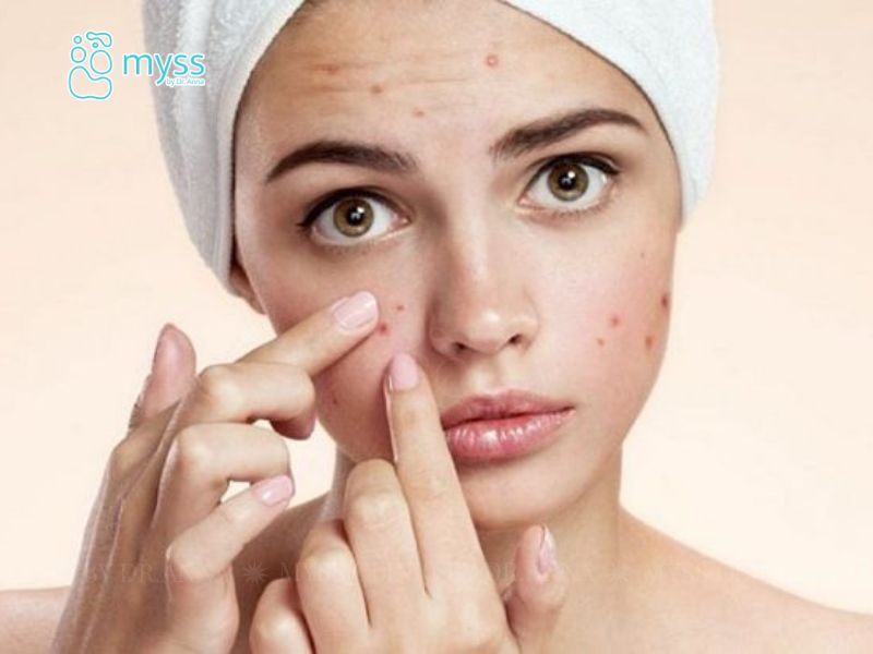 Phân biệt các loại mụn thường nổi trên da mặt
