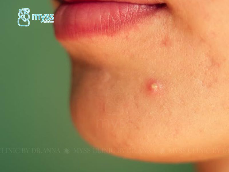 Da mặt bị nổi mụn nước và ngứa