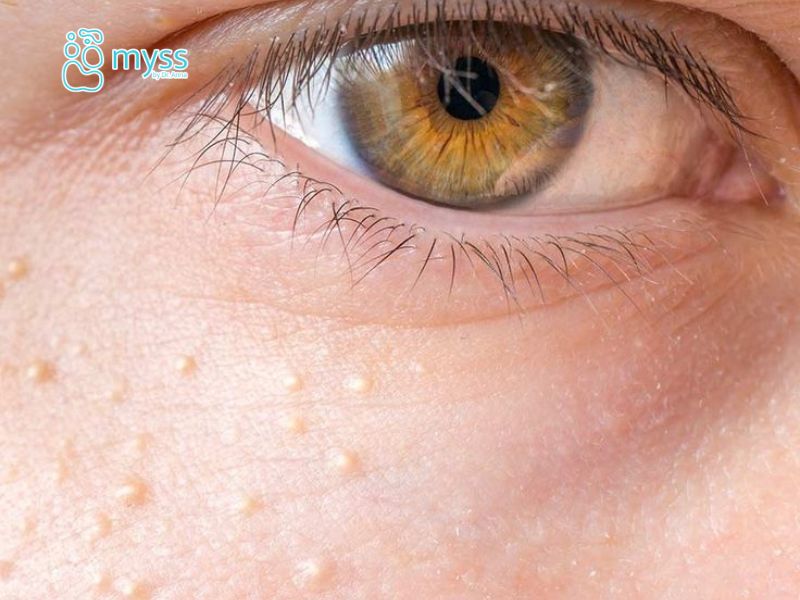 Mụn thịt là gì? Nguyên nhân, dấu hiệu và cách điều trị