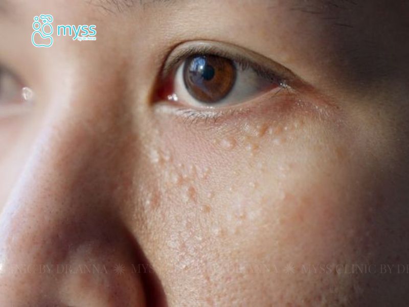 Mụn thịt có chữa được không?