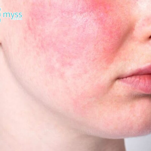 Peel da bị bỏng phải làm sao? Cách xử lý nhanh chóng