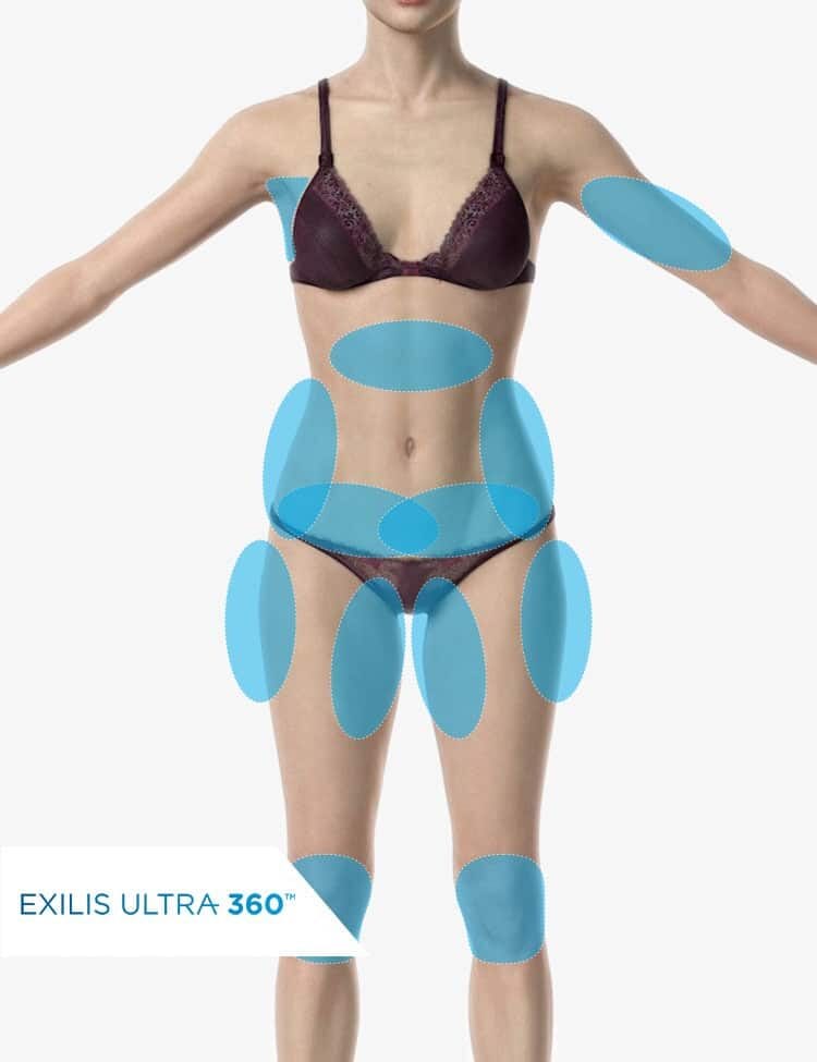 Thiết bị Exilis Ultra 360 tại Myss Clinic