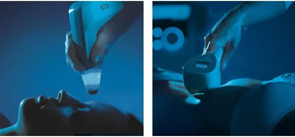 Ứng dụng Exilis Ultra 360 cho vùng mặt và cơ thể