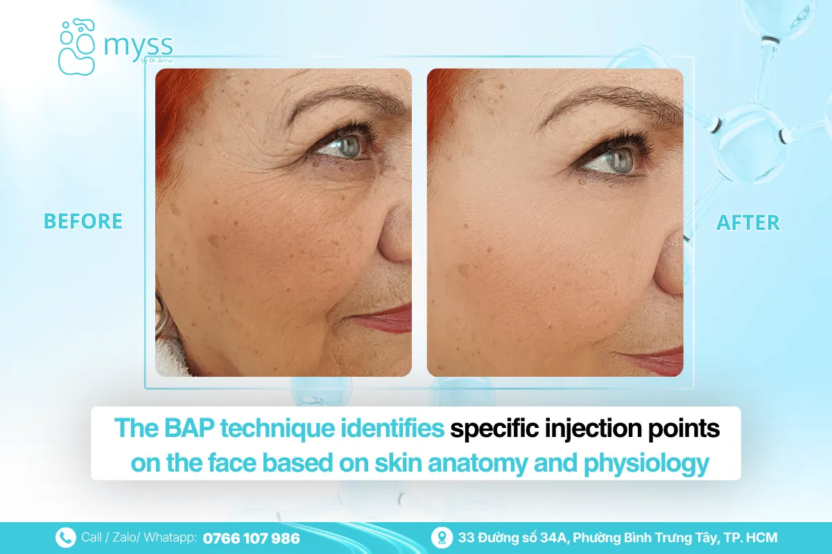 Before vs After Karisma BAP injection