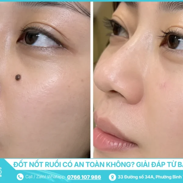Đốt Nốt Ruồi Có An Toàn Không - Giải Đáp Từ Bác Sĩ Da Liễu