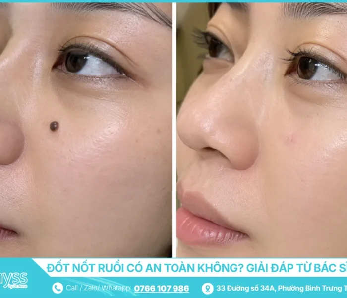 Đốt Nốt Ruồi Có An Toàn Không - Giải Đáp Từ Bác Sĩ Da Liễu