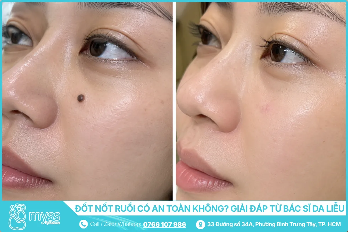 Đốt Nốt Ruồi Có An Toàn Không - Giải Đáp Từ Bác Sĩ Da Liễu