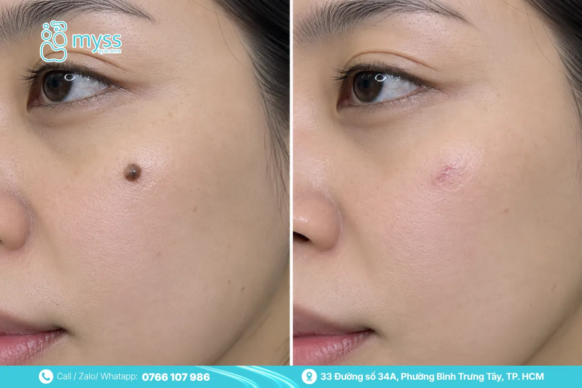 Đốt nốt ruồi để lại sẹo theo từng cơ địa