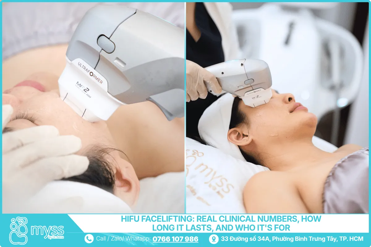 HIFU Facelifting - Real Clinical Numbers, How Long It Lasts, and Who It's For.
