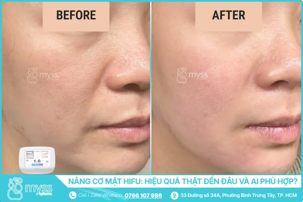 Hiệu quả nâng cơ mặt thực tế của HIFU