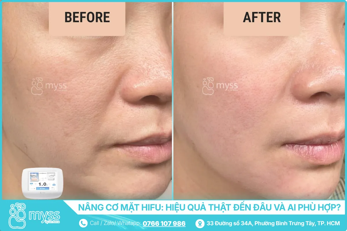 Hiệu quả nâng cơ mặt thực tế của HIFU