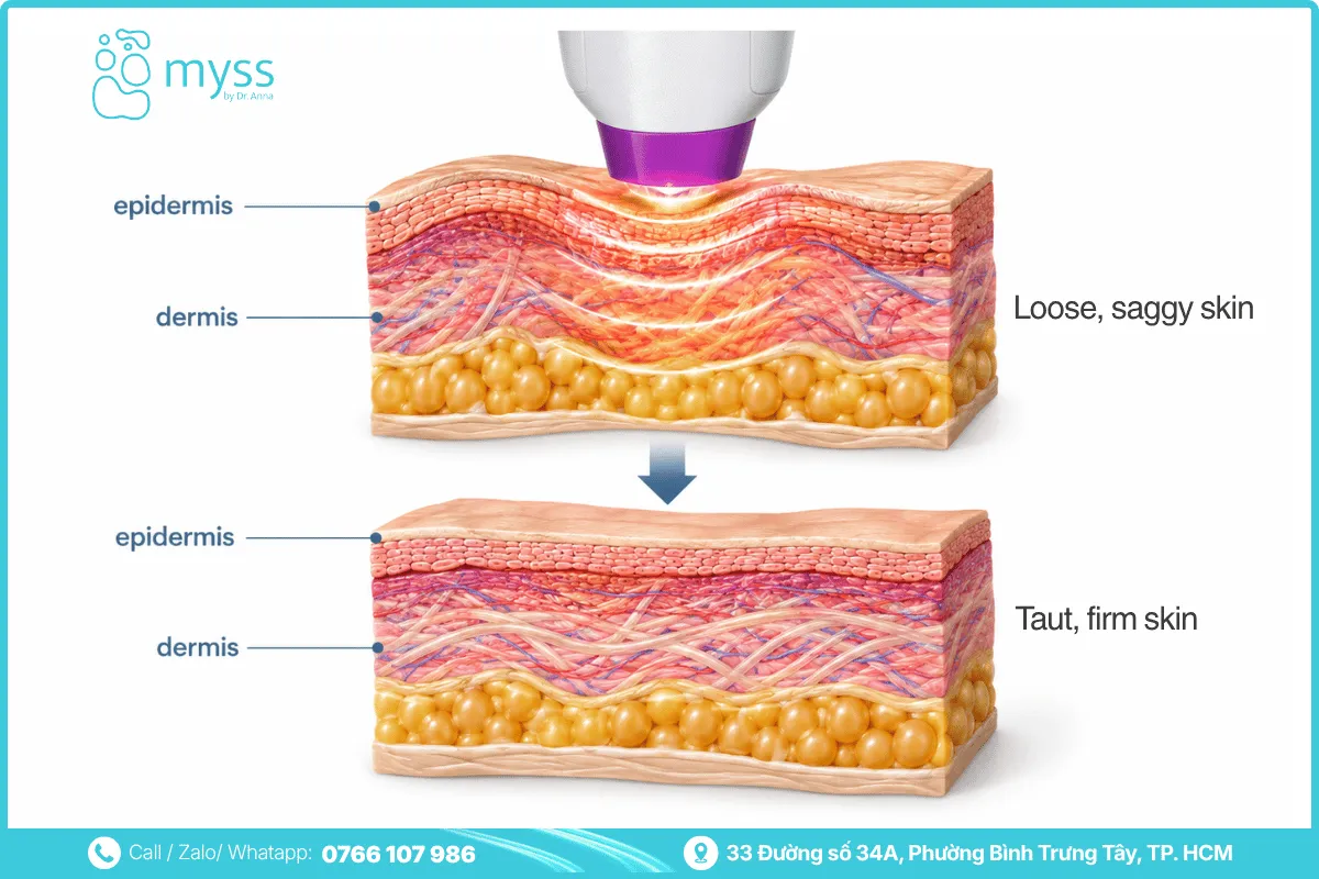How Thermage works