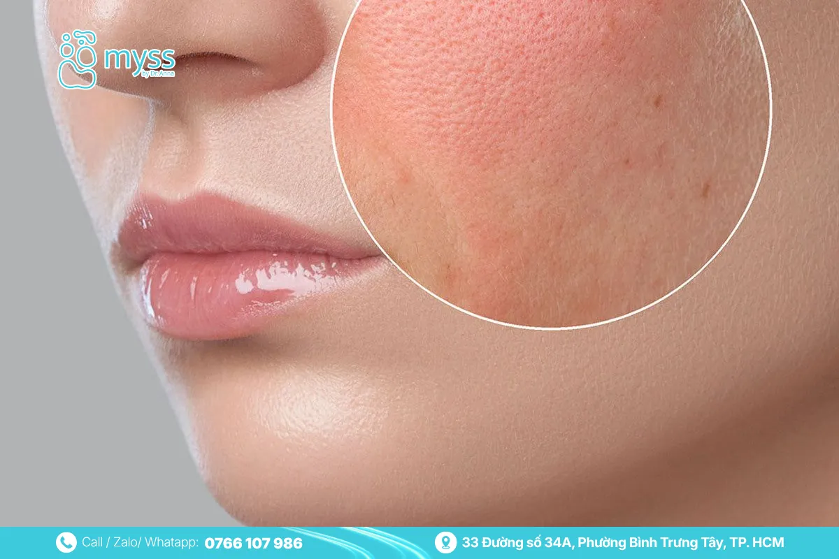 Liên hệ Bác sĩ nếu da ửng đỏ sau khi thực hiện Thermage