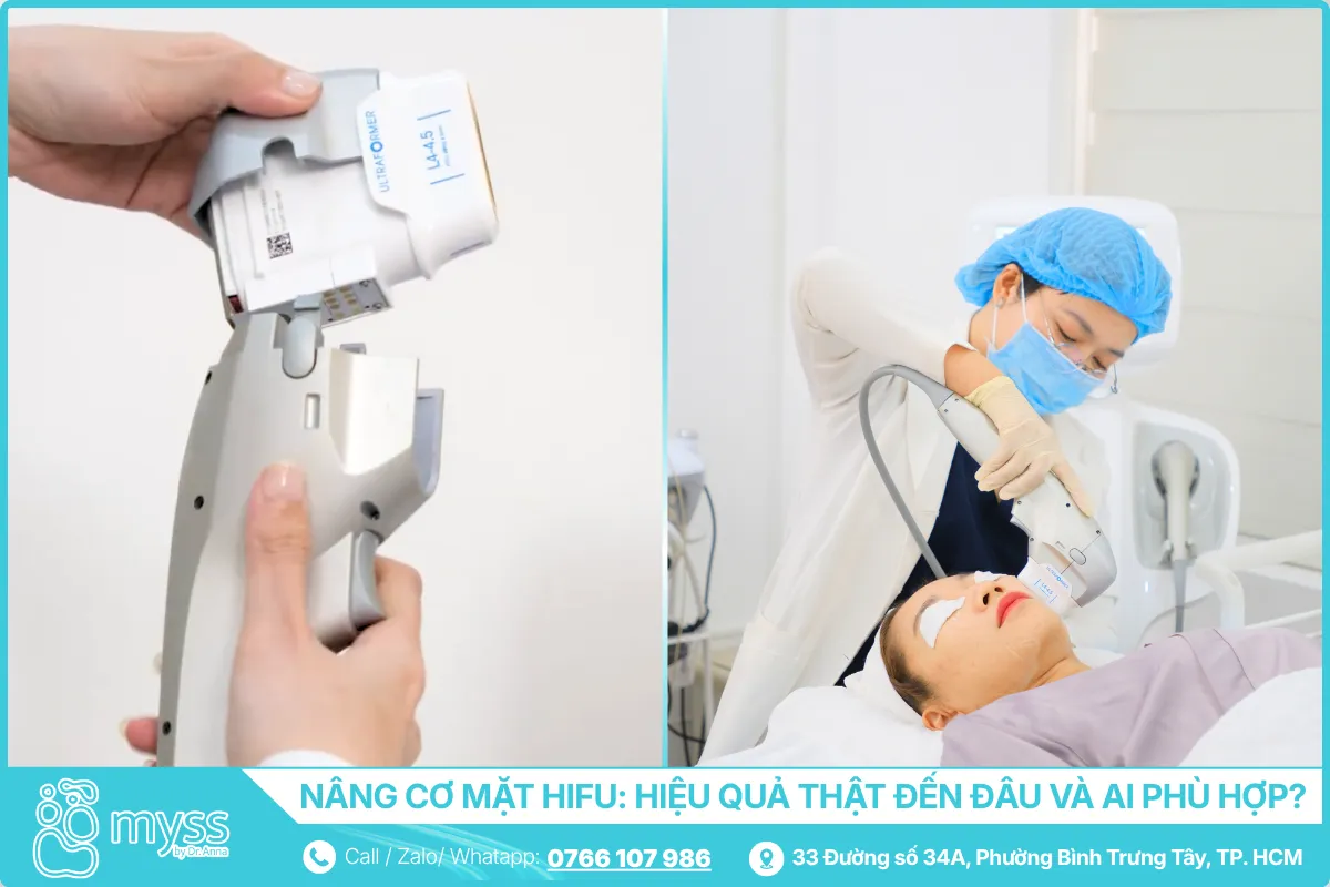 Nâng cơ mặt HIFU - Hiệu quả thật đến đâu và ai phù hợp