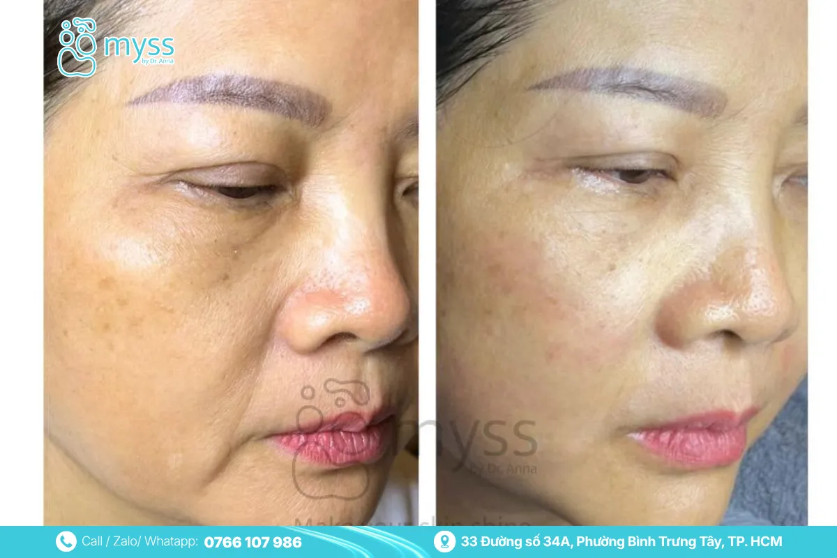 Signs of skin aging and why rejuvenation matters