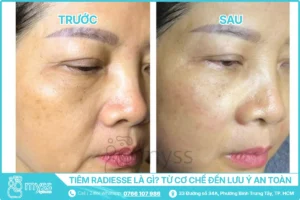 Tiêm Radiesse Là Gì - Bác Sĩ Da Liễu Giải Thích Từ Cơ Chế Đến Lưu Ý An Toàn