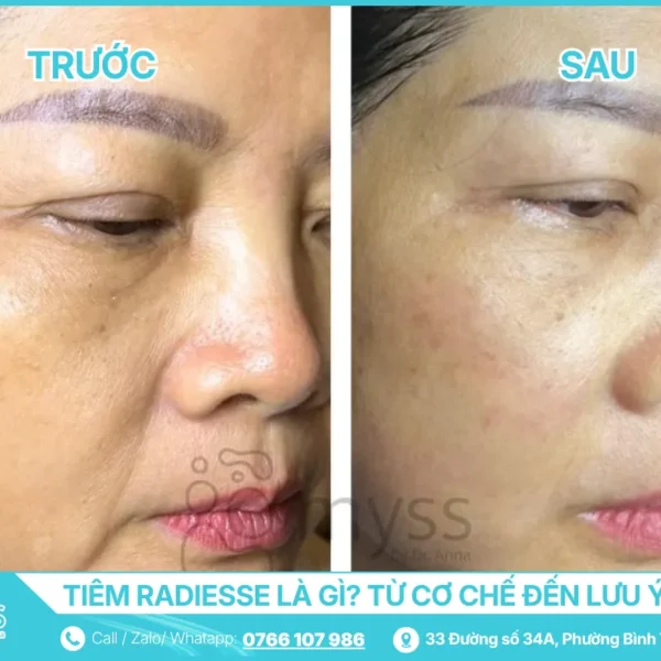 Tiêm Radiesse Là Gì - Bác Sĩ Da Liễu Giải Thích Từ Cơ Chế Đến Lưu Ý An Toàn